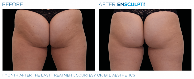 Before & After | EMSCULPT NEO | Dr. Patricia L. James