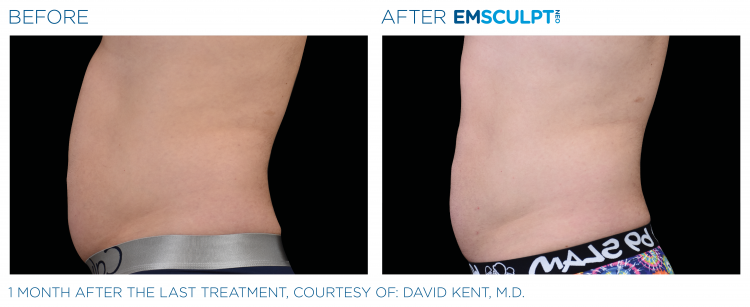 Before & After | EMSCULPT NEO | Dr. Patricia L. James