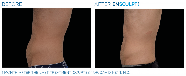 Before & After | EMSCULPT NEO | Dr. Patricia L. James